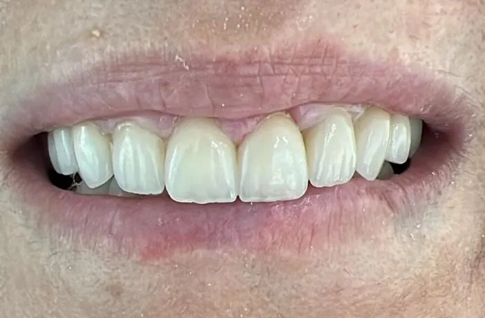 قشور إيماكس طبيعية: ابتسامة هوليود بمظهر طبيعي بعد